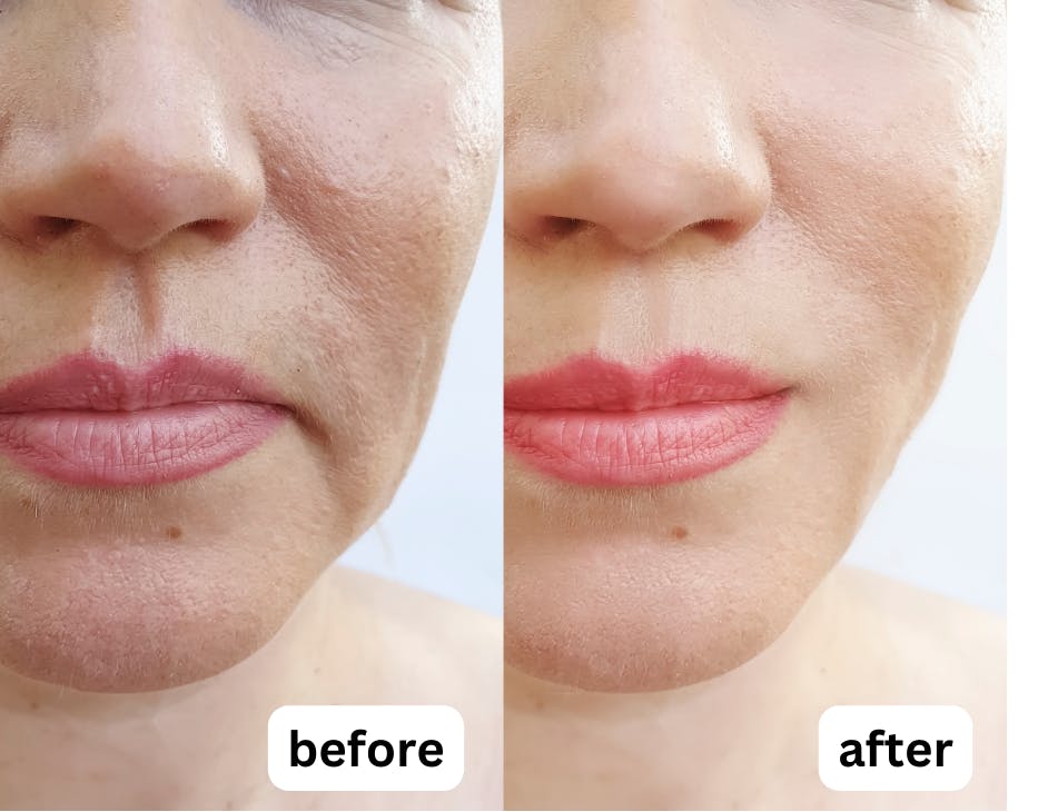 GlowMask Pro Light Therapy