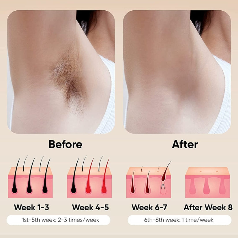 Renelle Radiance IPL