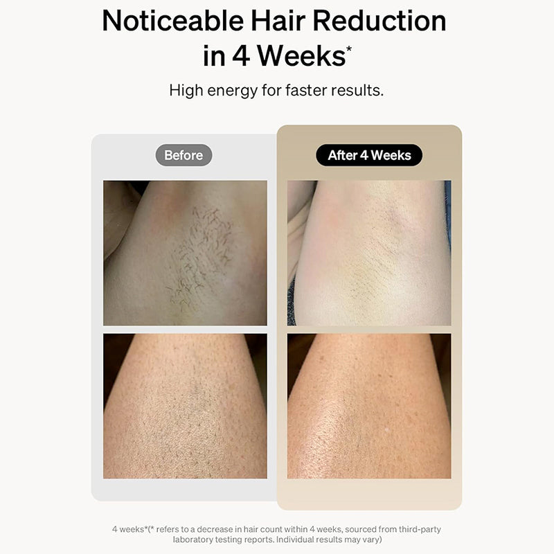 Renelle Radiance IPL